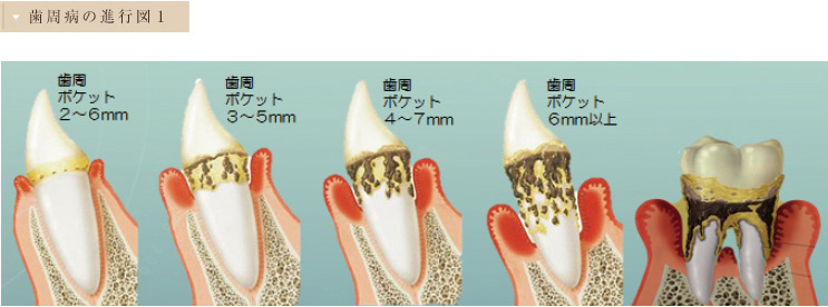 歯周病の進行図1